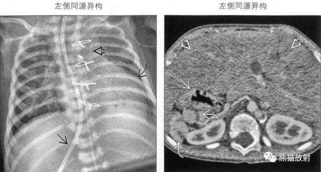 kartagener综合征、内脏异位综合征 kartagener综合征、内脏异位综合征