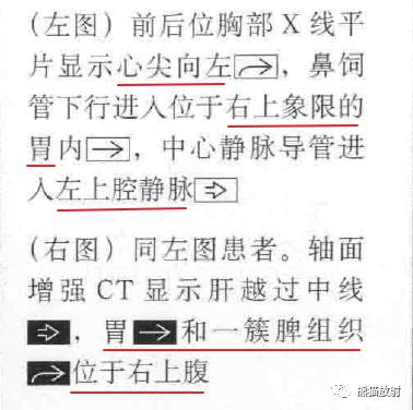 kartagener综合征、内脏异位综合征 kartagener综合征、内脏异位综合征