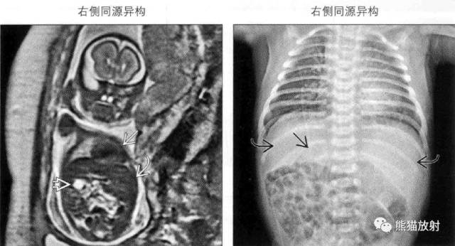 kartagener综合征、内脏异位综合征 kartagener综合征、内脏异位综合征