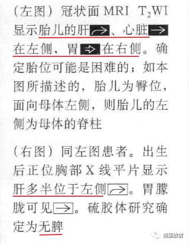 kartagener综合征、内脏异位综合征 kartagener综合征、内脏异位综合征