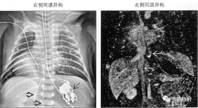kartagener综合征、内脏异位综合征 kartagener综合征、内脏异位综合征