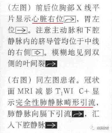 kartagener综合征、内脏异位综合征 kartagener综合征、内脏异位综合征