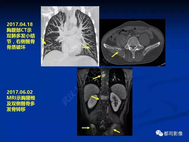 【PPT】头颈部腺样囊性癌伴周围神经浸润影像诊断
