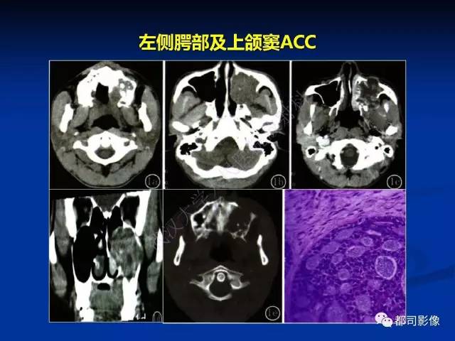 【PPT】头颈部腺样囊性癌伴周围神经浸润影像诊断