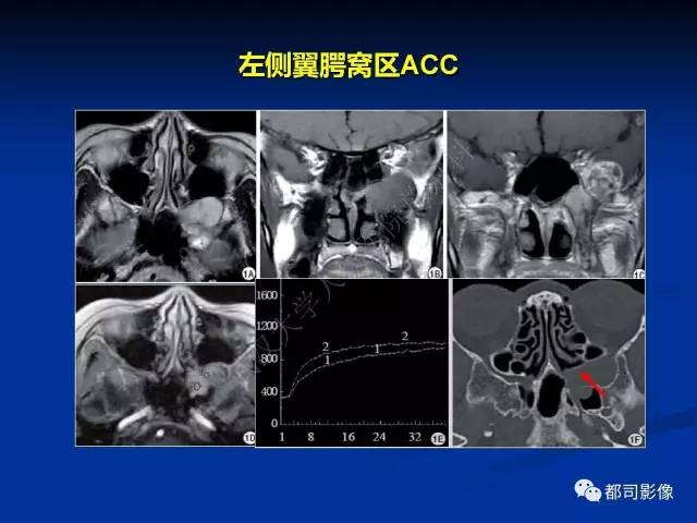 【PPT】头颈部腺样囊性癌伴周围神经浸润影像诊断