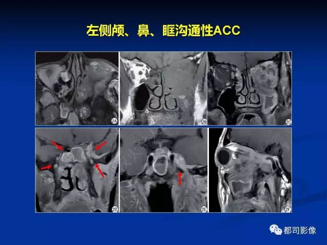 【PPT】头颈部腺样囊性癌伴周围神经浸润影像诊断