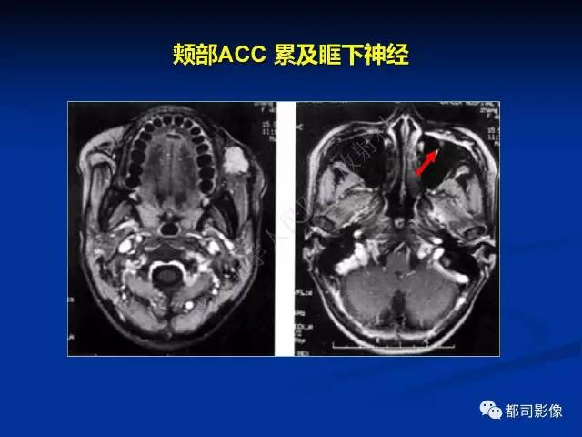 【PPT】头颈部腺样囊性癌伴周围神经浸润影像诊断