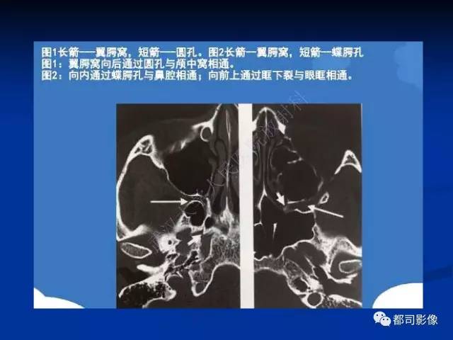 【PPT】头颈部腺样囊性癌伴周围神经浸润影像诊断