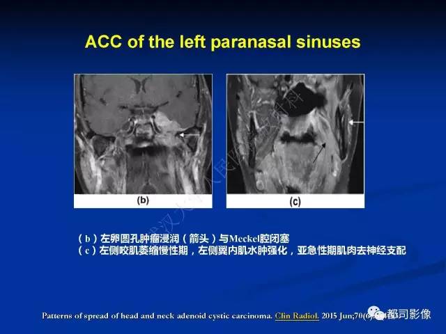 【PPT】头颈部腺样囊性癌伴周围神经浸润影像诊断
