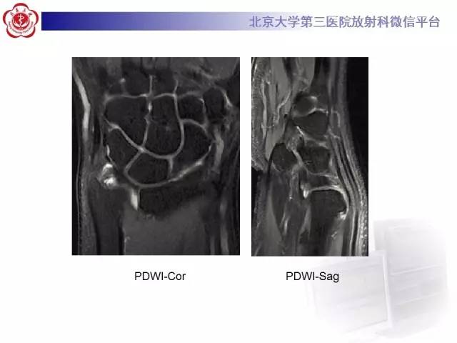 【病例】三角纤维软骨复合体损伤1例MR