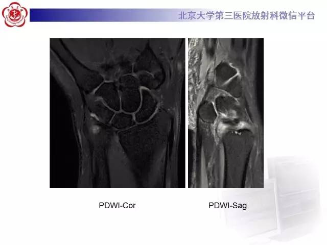 【病例】三角纤维软骨复合体损伤1例MR