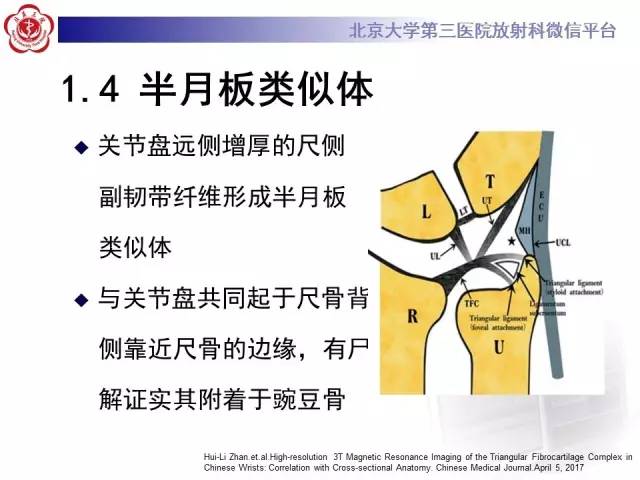 【病例】三角纤维软骨复合体损伤1例MR