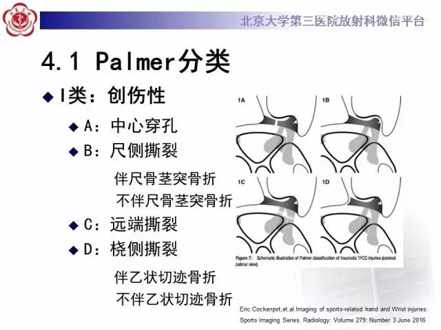【病例】三角纤维软骨复合体损伤1例MR