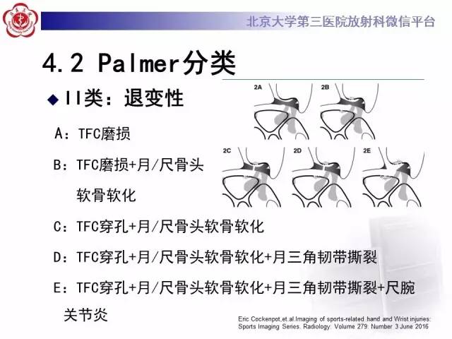 【病例】三角纤维软骨复合体损伤1例MR