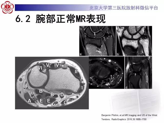 【病例】三角纤维软骨复合体损伤1例MR