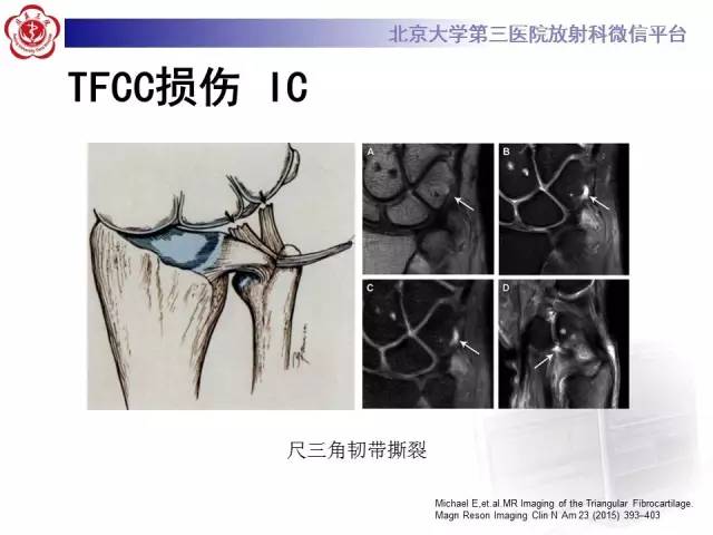 【病例】三角纤维软骨复合体损伤1例MR
