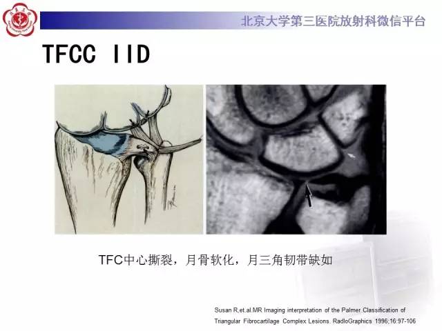 【病例】三角纤维软骨复合体损伤1例MR