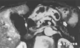 18种胰腺肿瘤，您掌握了吗？