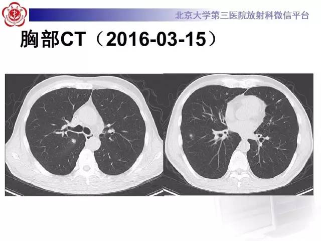 【病例】淋巴瘤并发肺癌1例CT