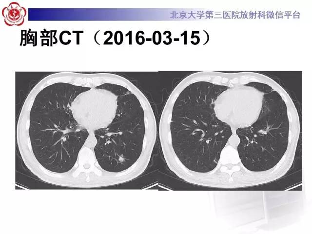 【病例】淋巴瘤并发肺癌1例CT