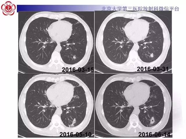 【病例】淋巴瘤并发肺癌1例CT