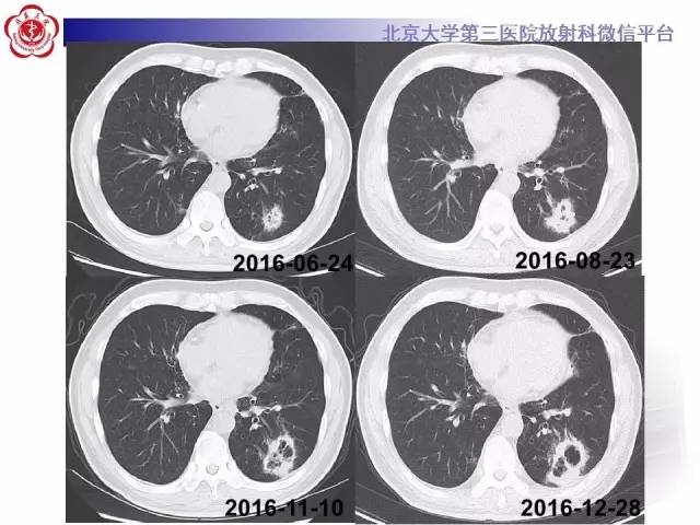 【病例】淋巴瘤并发肺癌1例CT