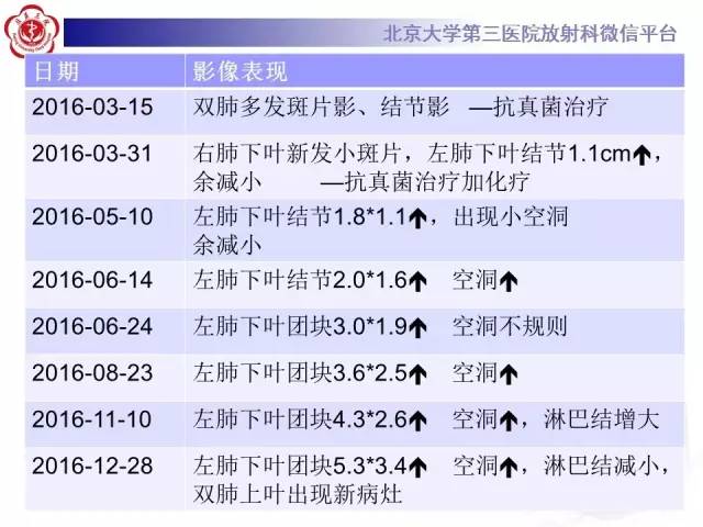 【病例】淋巴瘤并发肺癌1例CT