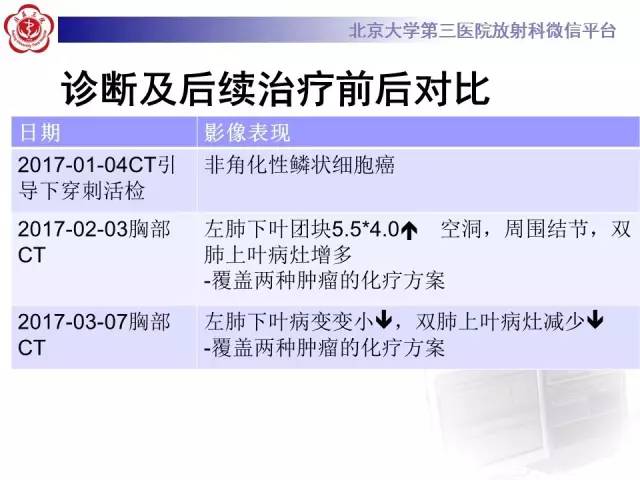 【病例】淋巴瘤并发肺癌1例CT