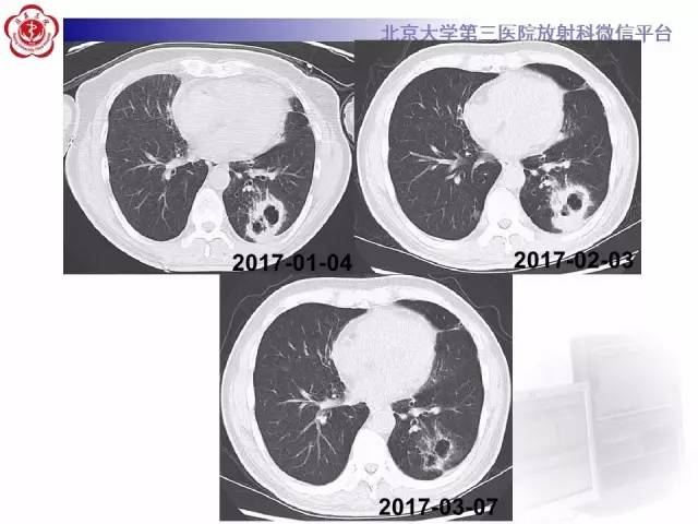 【病例】淋巴瘤并发肺癌1例CT