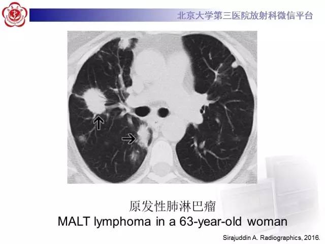 【病例】淋巴瘤并发肺癌1例CT