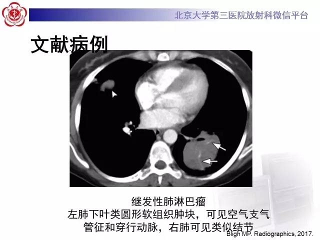 【病例】淋巴瘤并发肺癌1例CT