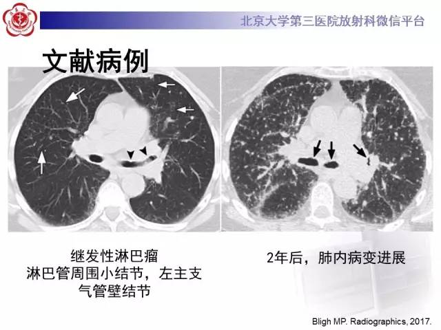 【病例】淋巴瘤并发肺癌1例CT