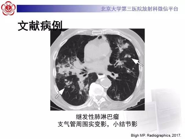 【病例】淋巴瘤并发肺癌1例CT