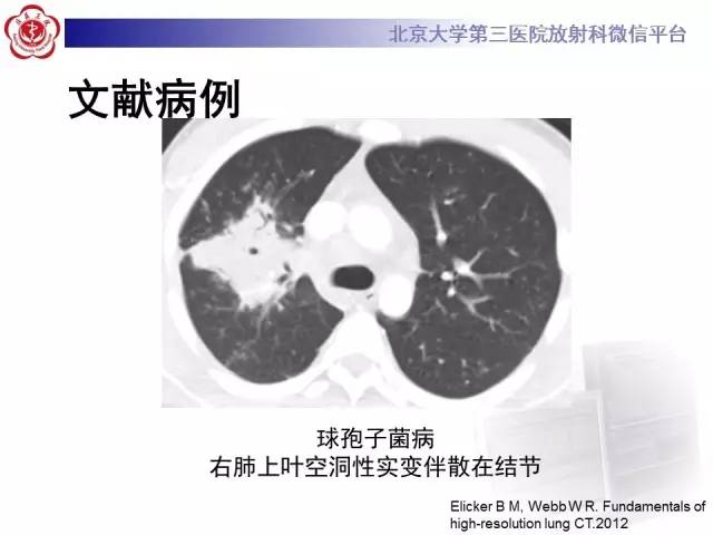 【病例】淋巴瘤并发肺癌1例CT