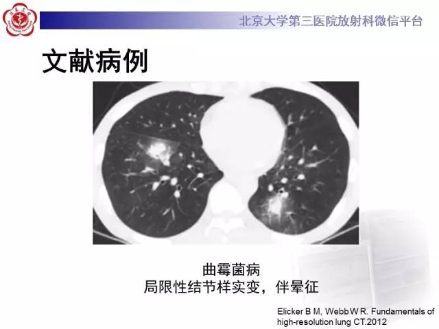 【病例】淋巴瘤并发肺癌1例CT