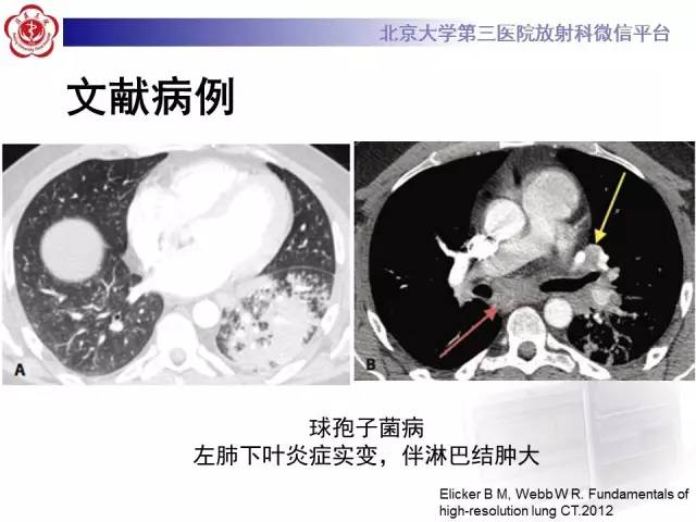 【病例】淋巴瘤并发肺癌1例CT