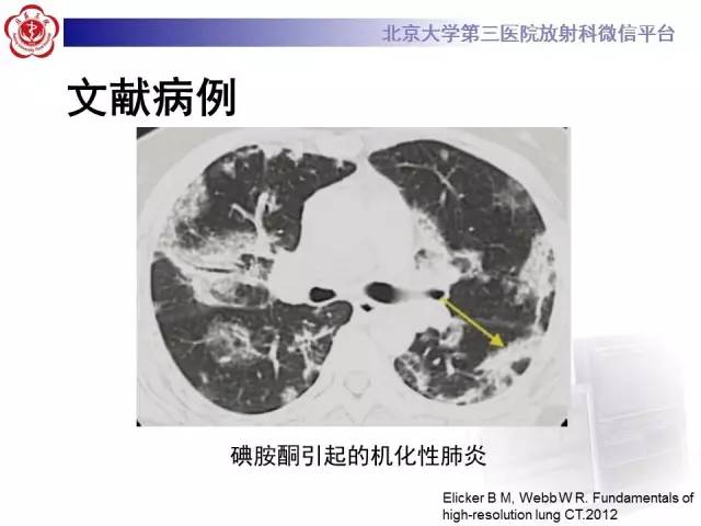 【病例】淋巴瘤并发肺癌1例CT