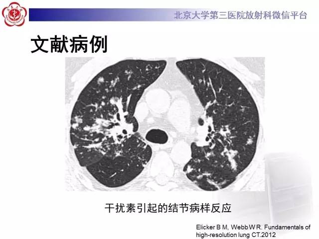 【病例】淋巴瘤并发肺癌1例CT