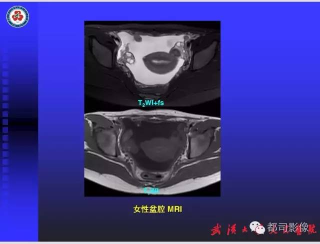 【PPT】妇科肿瘤临床MRI