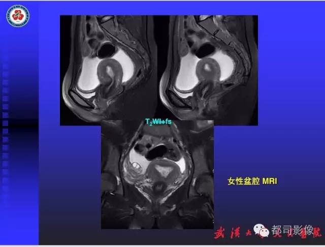 【PPT】妇科肿瘤临床MRI