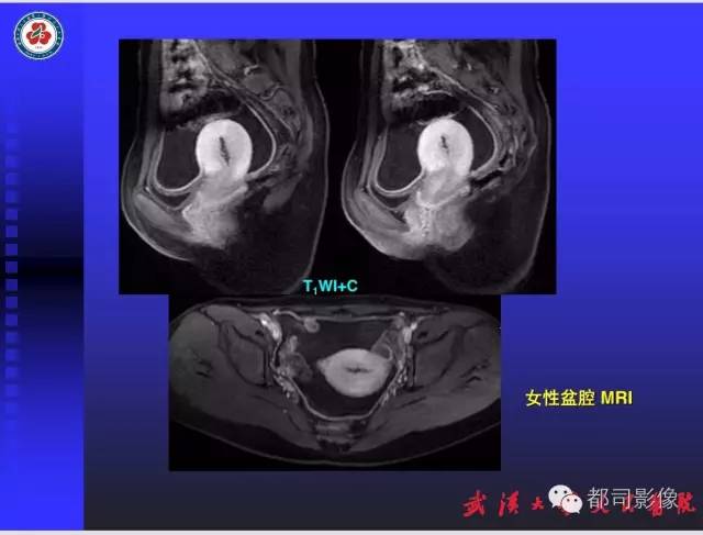 【PPT】妇科肿瘤临床MRI
