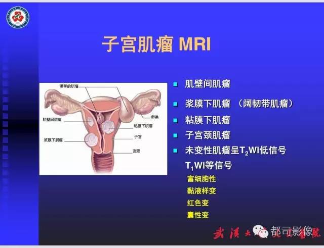 【PPT】妇科肿瘤临床MRI