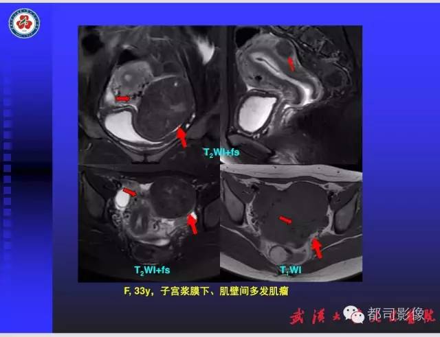 【PPT】妇科肿瘤临床MRI