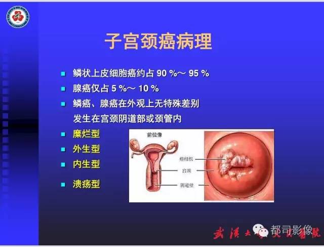 【PPT】妇科肿瘤临床MRI