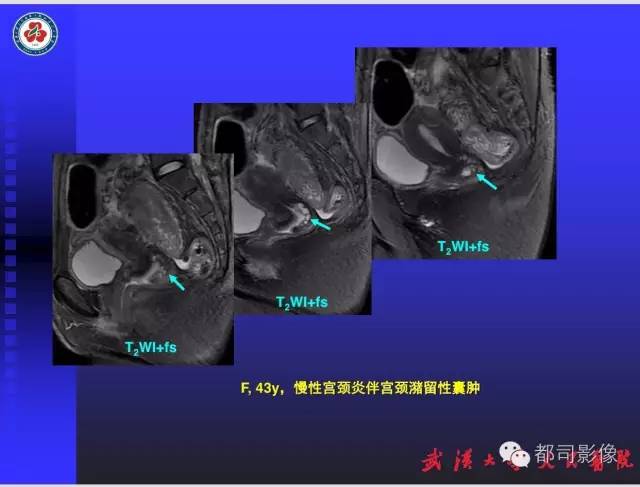 【PPT】妇科肿瘤临床MRI