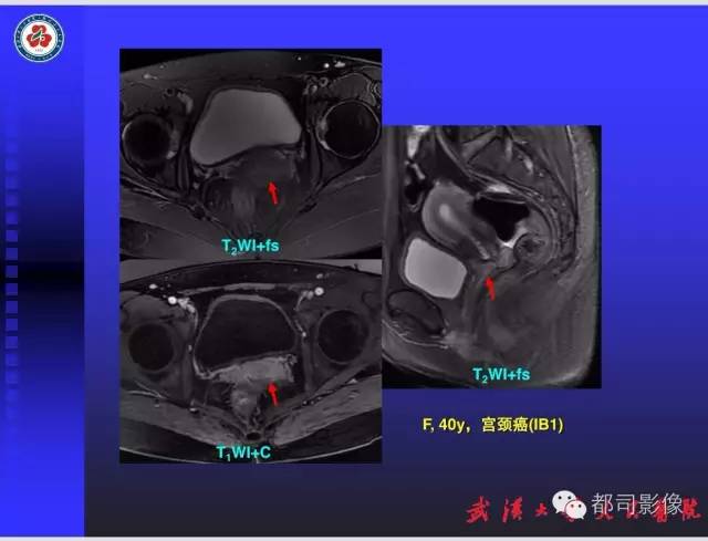 【PPT】妇科肿瘤临床MRI