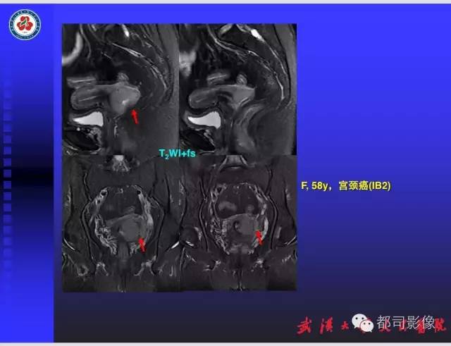 【PPT】妇科肿瘤临床MRI