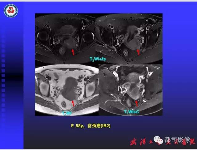【PPT】妇科肿瘤临床MRI