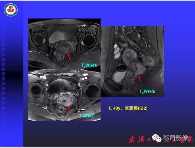 【PPT】妇科肿瘤临床MRI