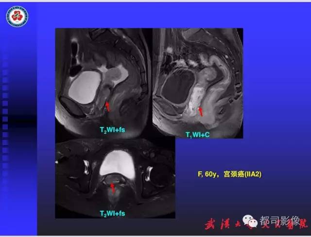 【PPT】妇科肿瘤临床MRI